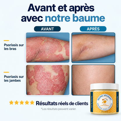 Baume Naturel Apaisant Psoriasis au Propolis