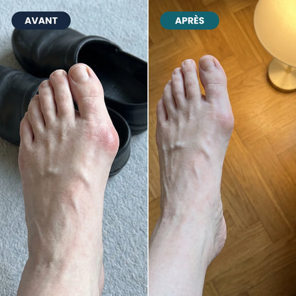 Zehenkorrektur mit sanfter Stimulation