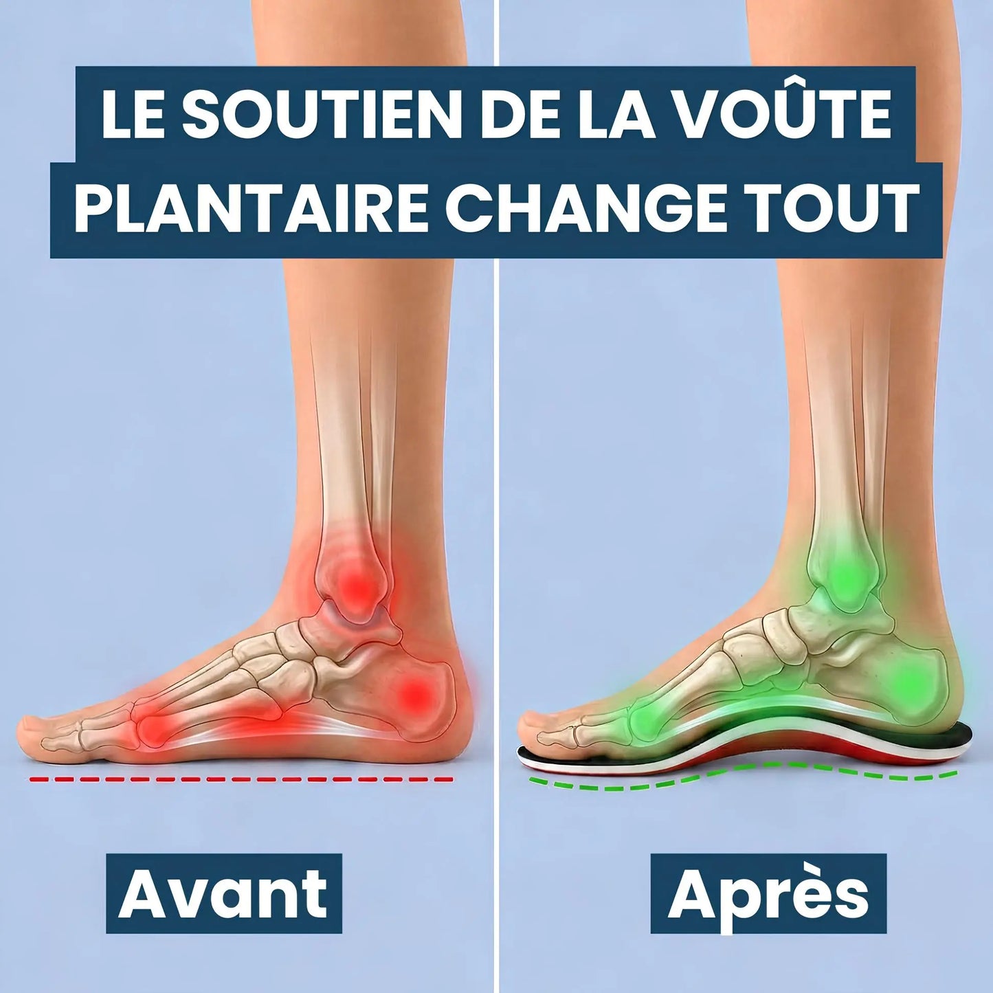Semelles Orthopédiques Pieds Plats