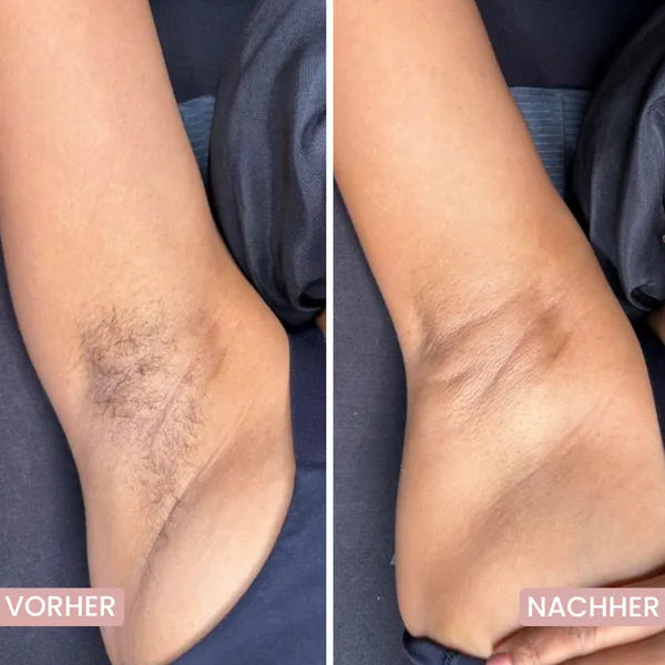 Hautschonender 5-in-1 Rasierer für empfindliche Zonen