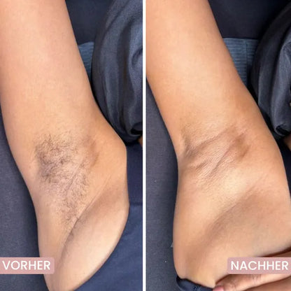 Hautschonender 5-in-1 Rasierer für empfindliche Zonen