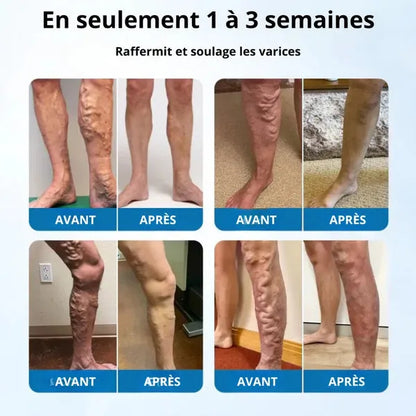 Spray réducteur de varices