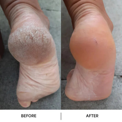 Smooviya Glow Pro – Élimination douce & efficace des callosités