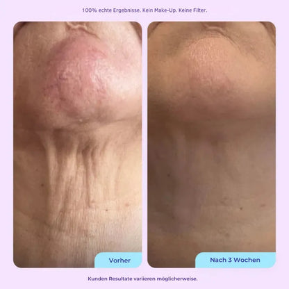 Pad cervical en silicone médical