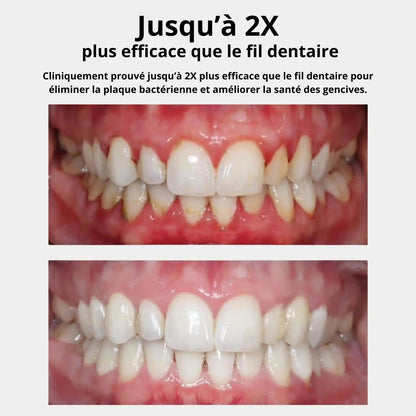 Hydropulseur Dentaire