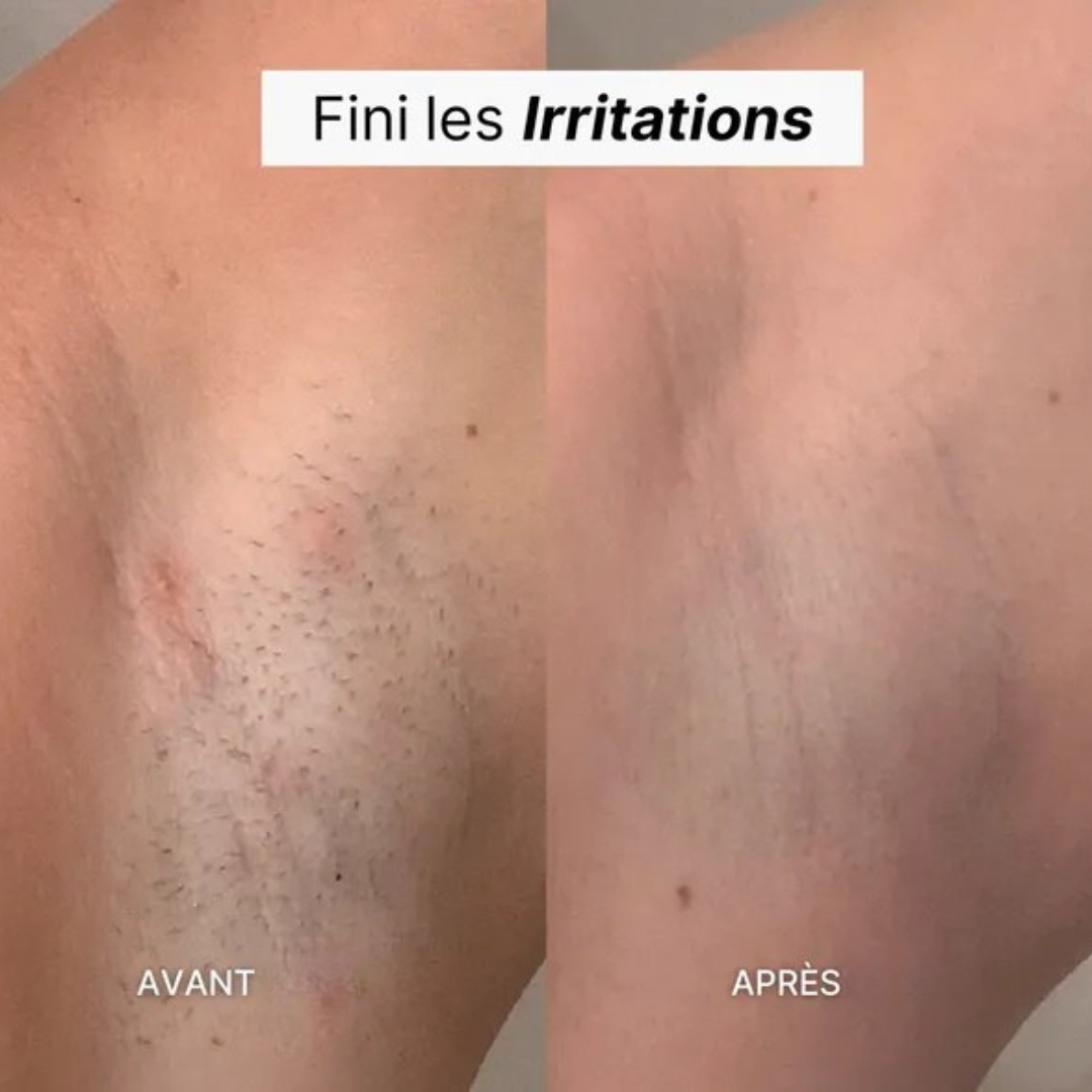 Sanftes Peeling-Epilierer