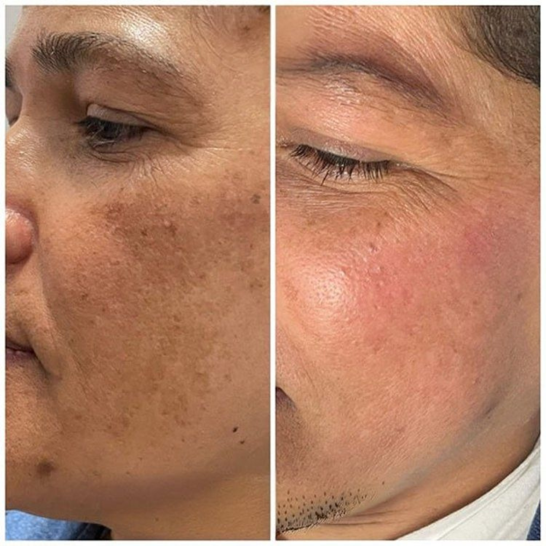 Creme gegen Pigmentflecken und Melasma