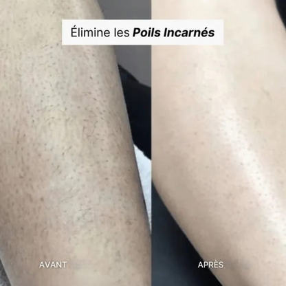 Sanftes Peeling-Epilierer