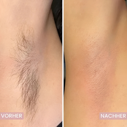 5-in-1 Haarentferner - Glatte Haut ohne Schnitte