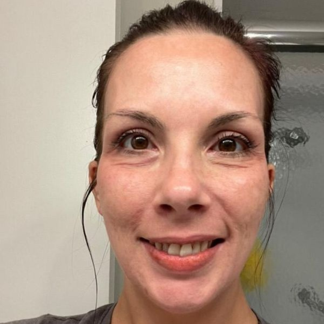 Creme gegen Pigmentflecken und Melasma