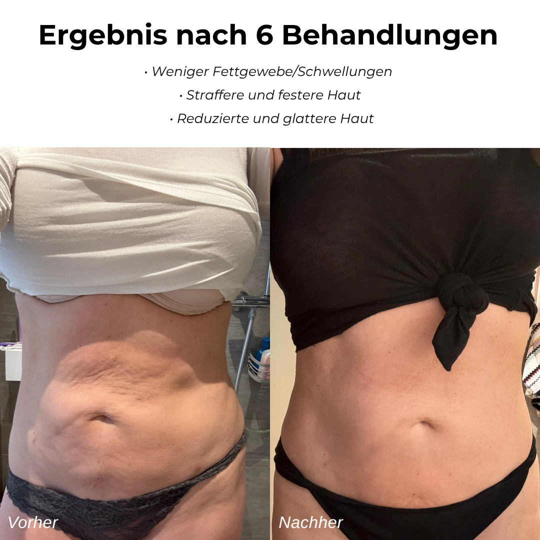 Beheizbares Anti-Cellulite-Massagegerät