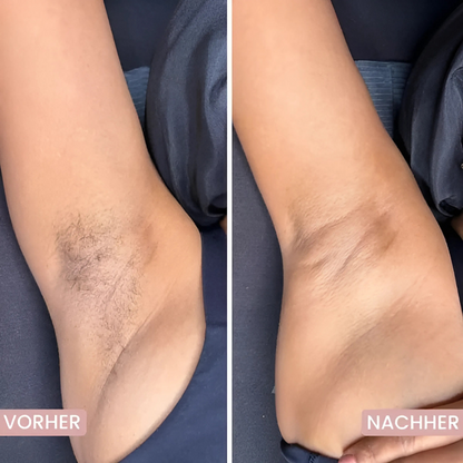 5-in-1 Haarentferner - Glatte Haut ohne Schnitte