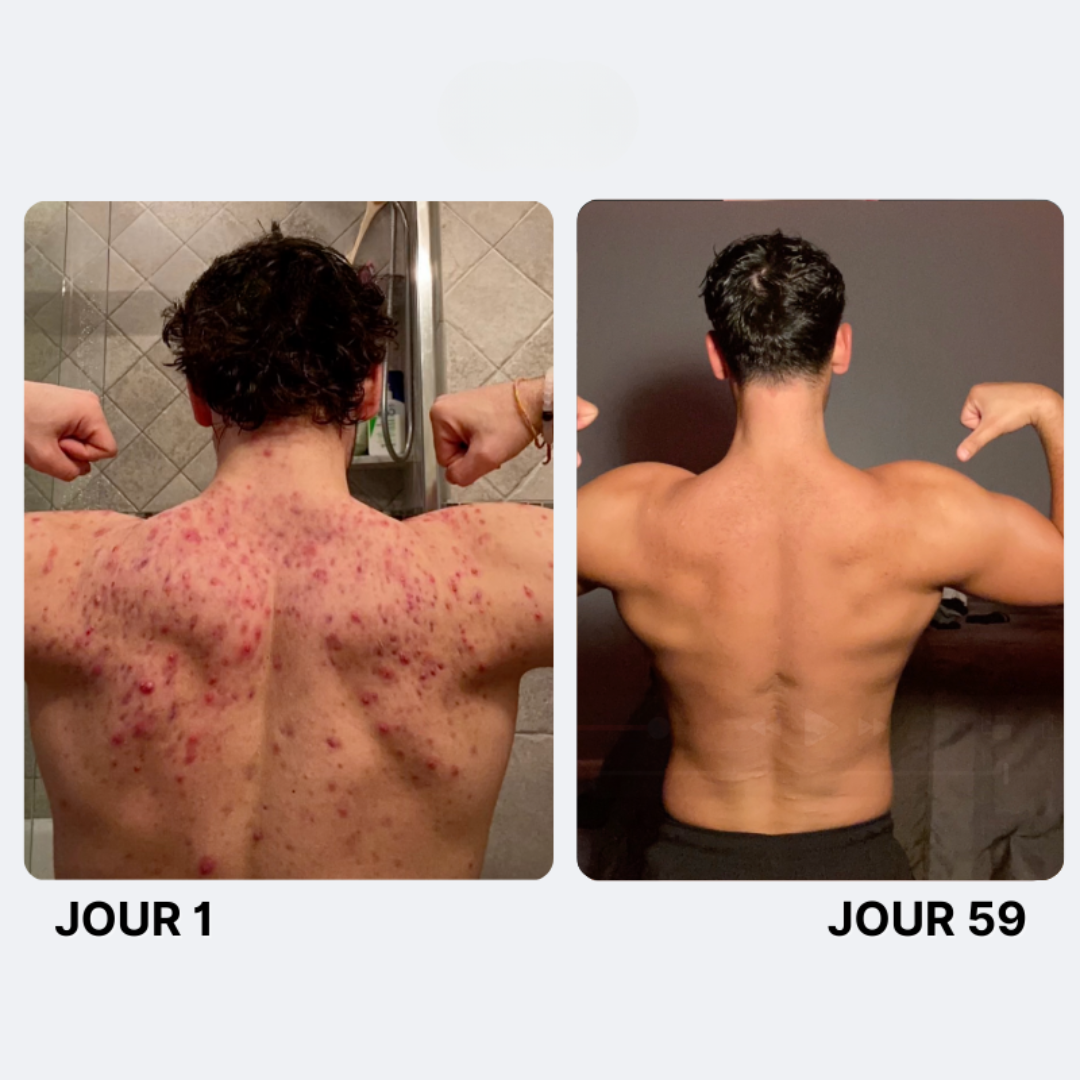 Reinigende Seife gegen Akne