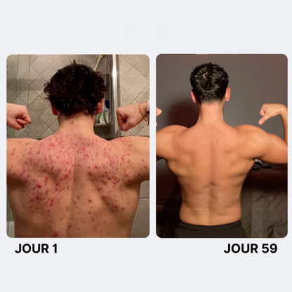 Reinigende Seife gegen Akne