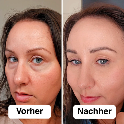 Gerät zur Gesichtsstraffung