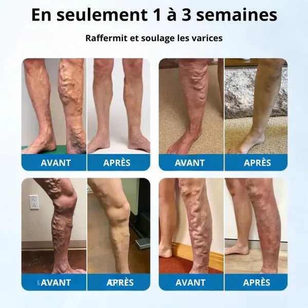 Spray zur Reduzierung von Krampfadern