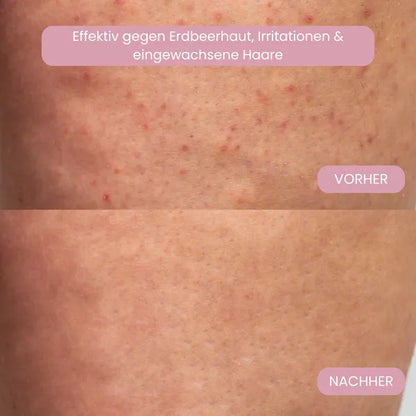 Haarentfernungs-Set ohne Reizungen