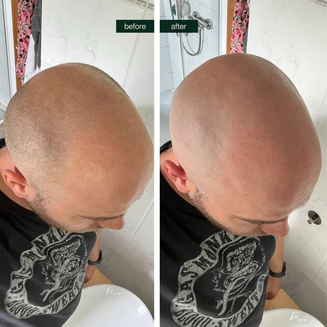 Set di Glatzenrasierer